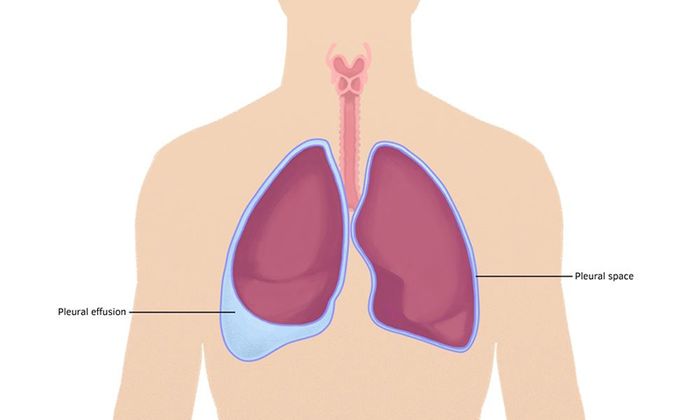 Mô tả hình ảnh về trạng thái tích tụ dịch trong khoang phổi