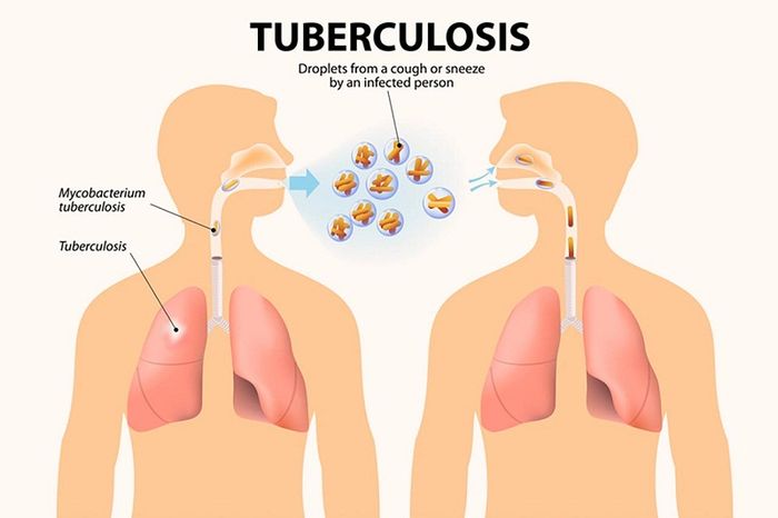 Lao phổi là bệnh lây truyền qua không khí