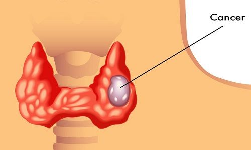 U tuyến giáp có thể phân thành 2 loại: lành tính và ác tính