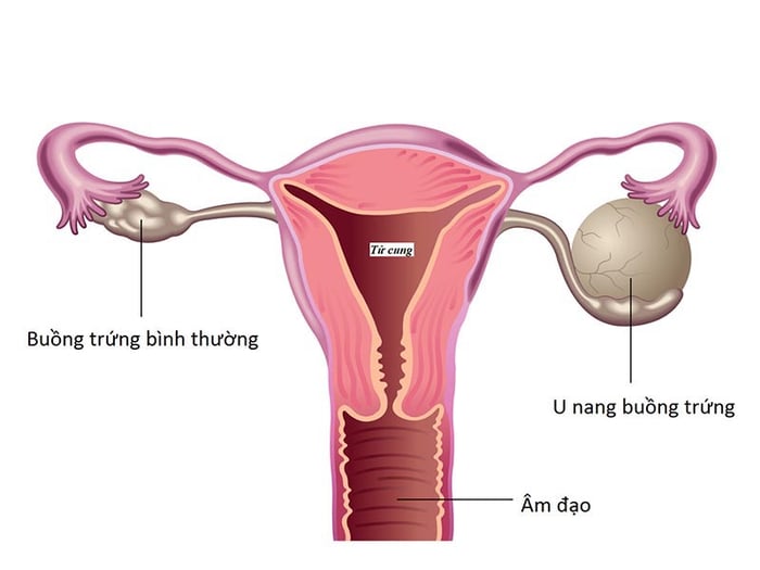 Nhận biết sự khác biệt giữa buồng trứng bình thường và u nang buồng trứng