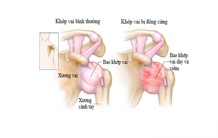 Thể đông cứng khớp vai trong bệnh viêm chu vai