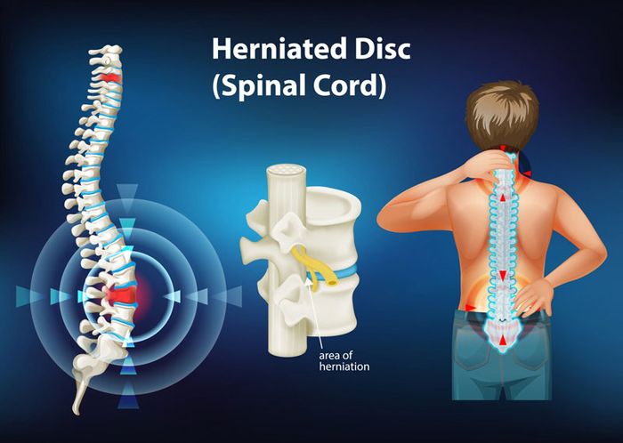 Người mắc thoát vị đĩa đệm thường gặp đau nhức ở vùng cổ, lưng 