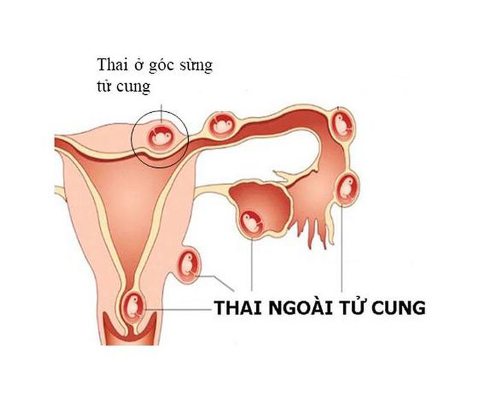 Hiện tượng mang thai ngoài tử cung là rất nguy hiểm đối với người mẹ.