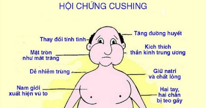 Dấu hiệu phổ biến thường gặp ở người mắc hội chứng Cushing