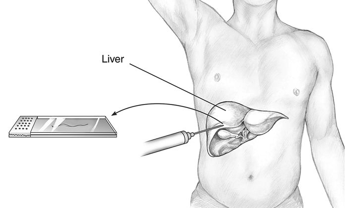 Phương pháp sinh thiết gan trong việc chẩn đoán gan nhiễm mỡ