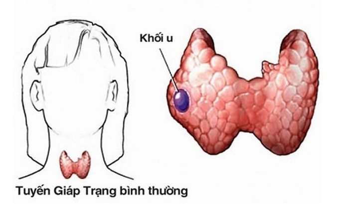 Liệu u tuyến giáp lành tính có cần phải phẫu thuật không?