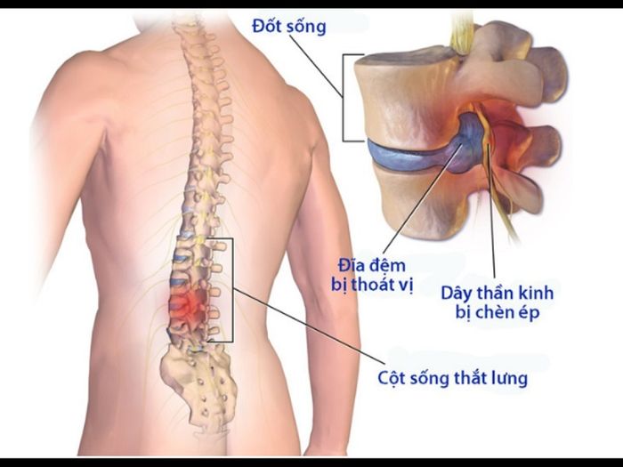 Vấn đề của đĩa đệm thoát ra khỏi vị trí bình thường là một bệnh lý phổ biến ở cột sống hiện nay