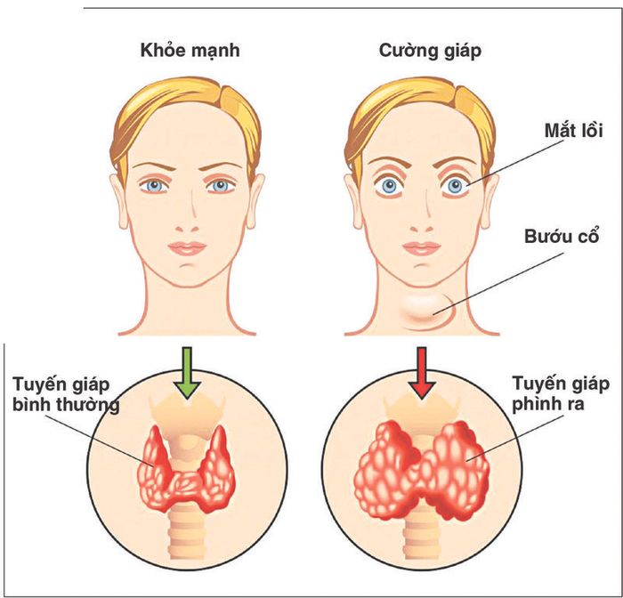 Cường giáp là kết quả của việc tăng sản xuất hormone tuyến giáp