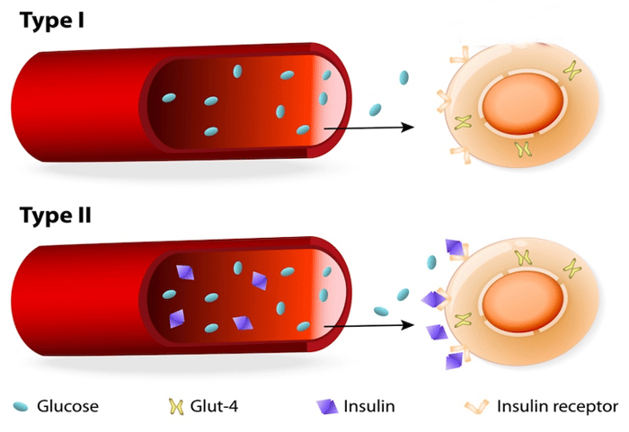 Type 1: thiếu Insulin, Glucose không vào tế bào. Type 2: kháng Insulin, Glucose đọng trong máu.