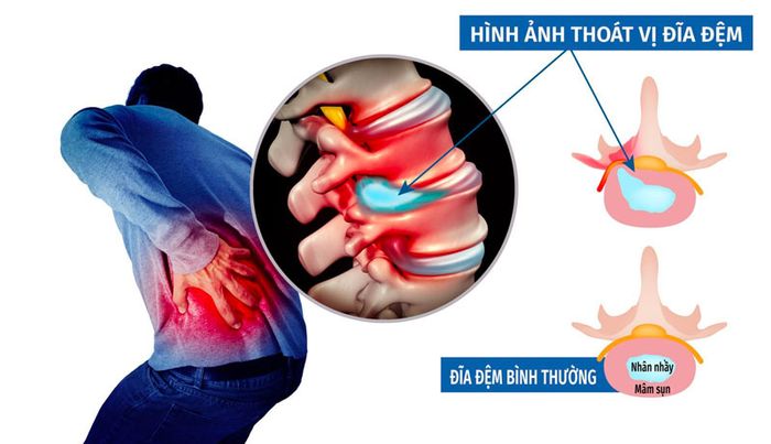 Thoát vị đĩa đệm có thể gây ra hậu quả nghiêm trọng cho sức khỏe