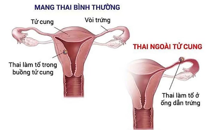 Thai bên ngoài tử cung đe dọa sức khỏe của mẹ bầu