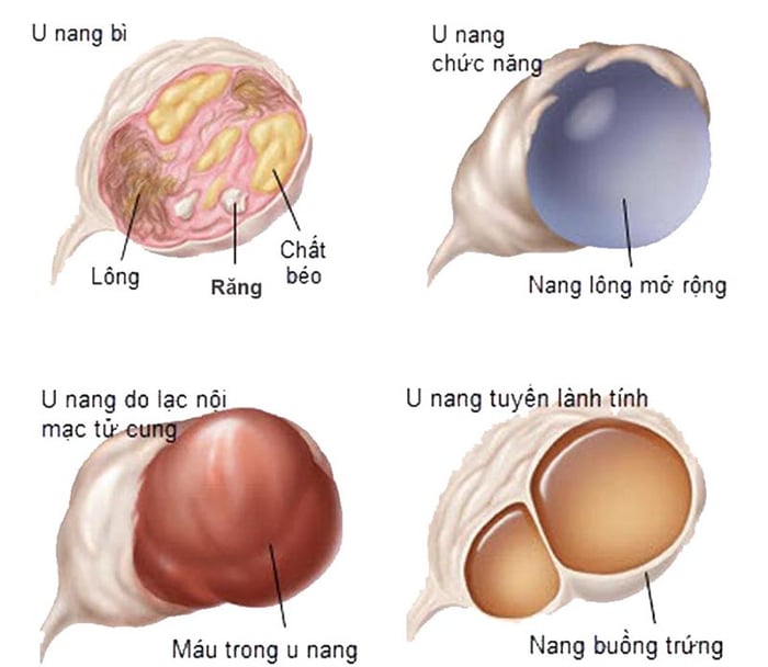 Phân loại u nang trong buồng trứng