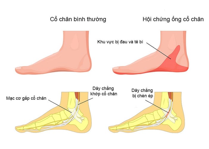 Khái niệm về ống cổ chân