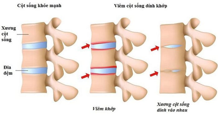 Viêm cột sống dính khớp nếu không được điều trị kịp thời có thể khiến cho các đốt sống lưng dính vào nhau