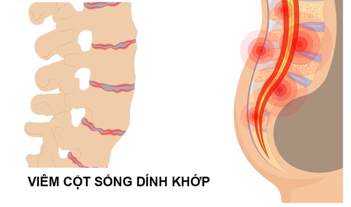 Bệnh viêm cột sống dính khớp xảy ra ở mối nối các đốt cột sống hoặc các khớp