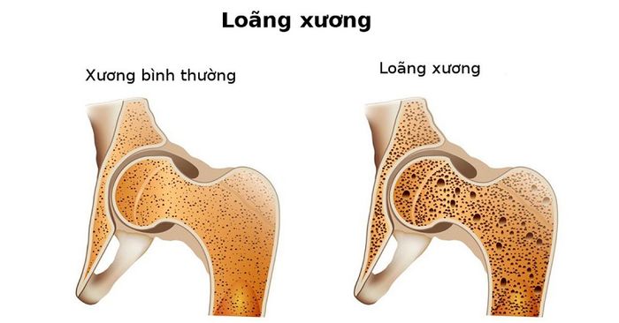 Loãng xương có thể được phát hiện sớm thông qua các xét nghiệm kiểm tra.