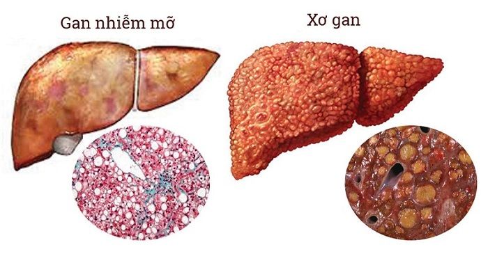 Gan nhiễm mỡ độ 2 và những điều cần biết