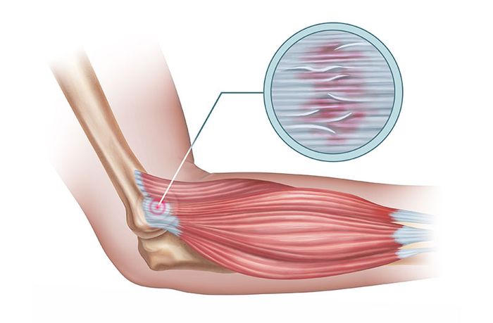 Mô phỏng tình hình giãn dây chằng cơ khuỷu tay