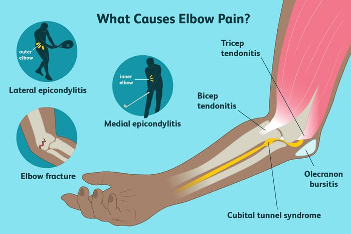 Có rất nhiều lý do gây đau nhức ở khuỷu tay