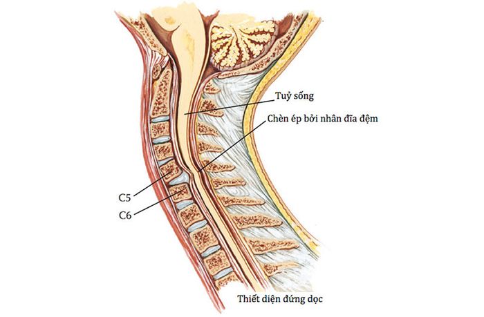 Bệnh Thoát Vị Nhân Tủy Là Gì?