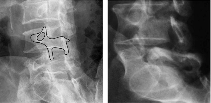 Hình ảnh của trượt đốt sống được phát hiện thông qua việc chụp X-quang 