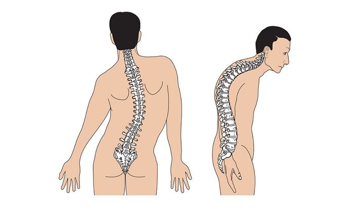 Biến dạng cột sống - một trong những trường hợp yêu cầu phẫu thuật cột sống lưng