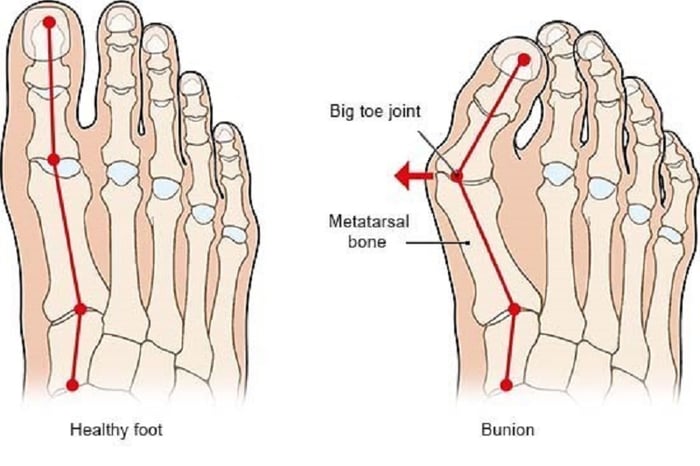 Hình minh họa so sánh giữa bàn chân bình thường (bên trái) và bàn chân Bunion (bên phải)