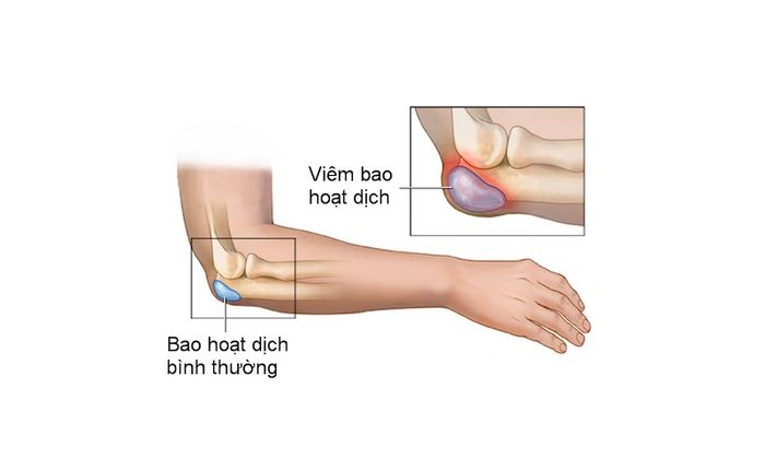 Hiểu đúng về viêm bao hoạt dịch khớp