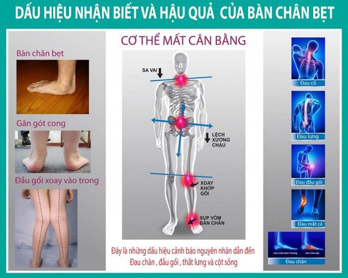 Bàn chân bẹt - ảnh hưởng đến sức khỏe