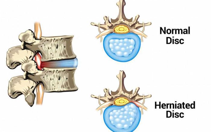 Thoát vị đĩa đệm là nguyên nhân gây đau thắt lưng cho bệnh nhân.