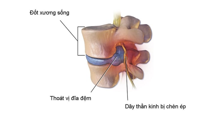 Hình ảnh minh họa về bệnh thoát vị đĩa đệm