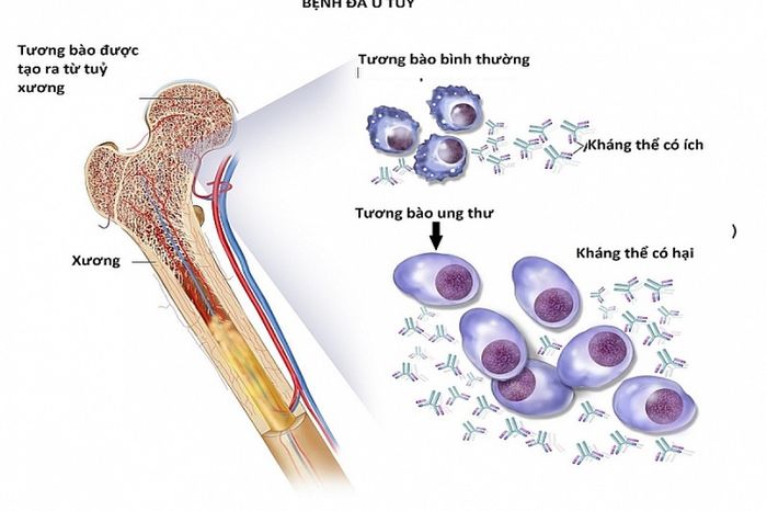Đa u tủy là loại ung thư máu ác tính, có đặc điểm là tương bào tăng sinh ở tủy xương và các cơ quan khác