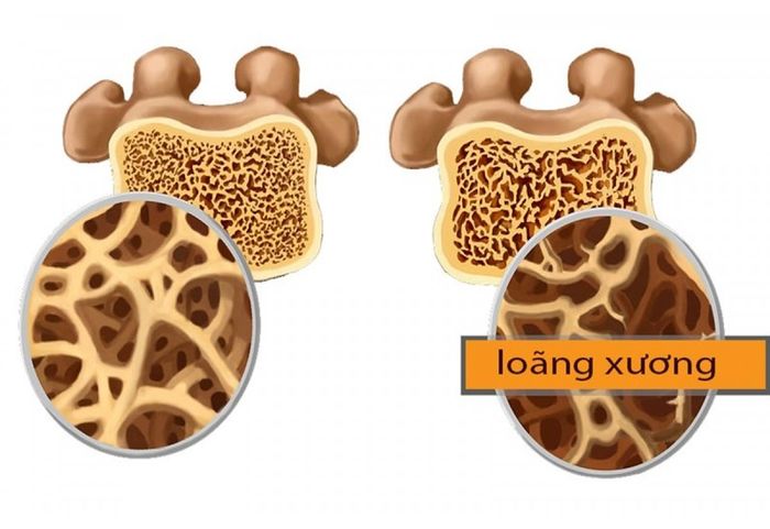 Loãng xương ở người trẻ có thể xuất phát từ một số nguyên nhân khác nhau