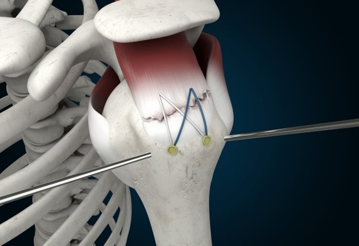 Phẫu thuật nối gân chóp xoay có thể giúp cải thiện hiệu quả điều trị