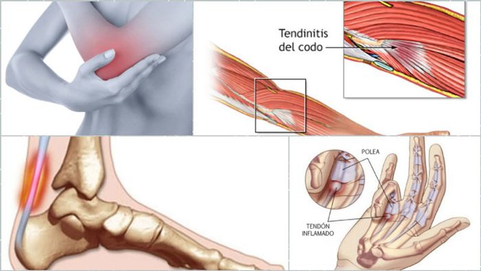 Viêm gân có thể xuất hiện ở nhiều vị trí trên cơ thể