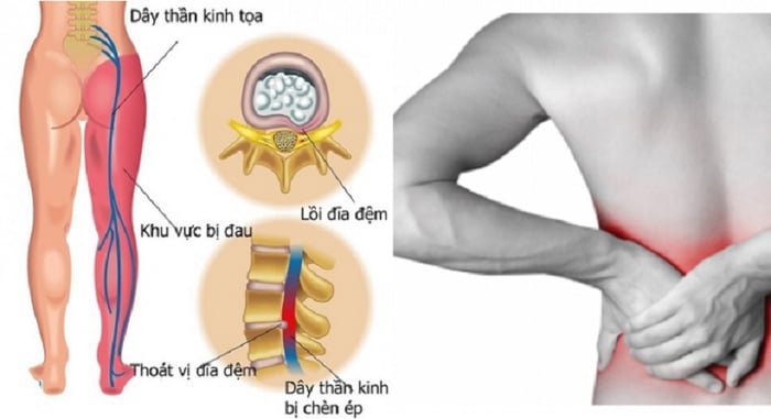 Thoát vị đĩa đệm thường dẫn đến đau và tê ở chân tay, thường cần phải phẫu thuật.