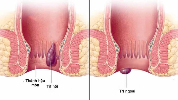 Trĩ nội và trĩ ngoại có các biểu hiện khác nhau.