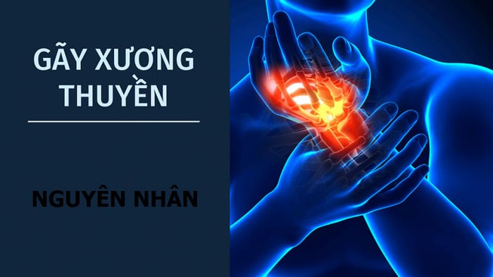 Các nguyên nhân dẫn đến gãy xương thuyền