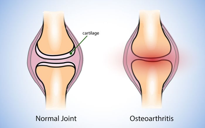 điều trị thoái hóa khớp