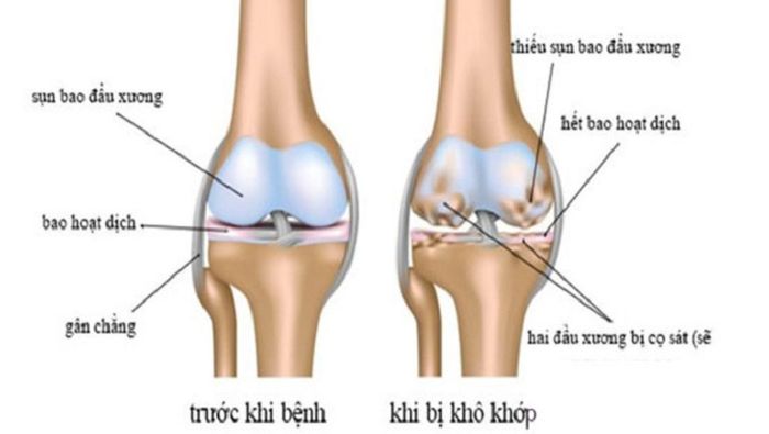 Đau khớp gối ở người trẻ tuổi có thể là biểu hiện của bệnh khô khớp gối