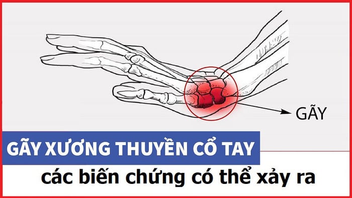 Xương thuyền bị gãy có thể gây ra những vấn đề phức tạp nào?