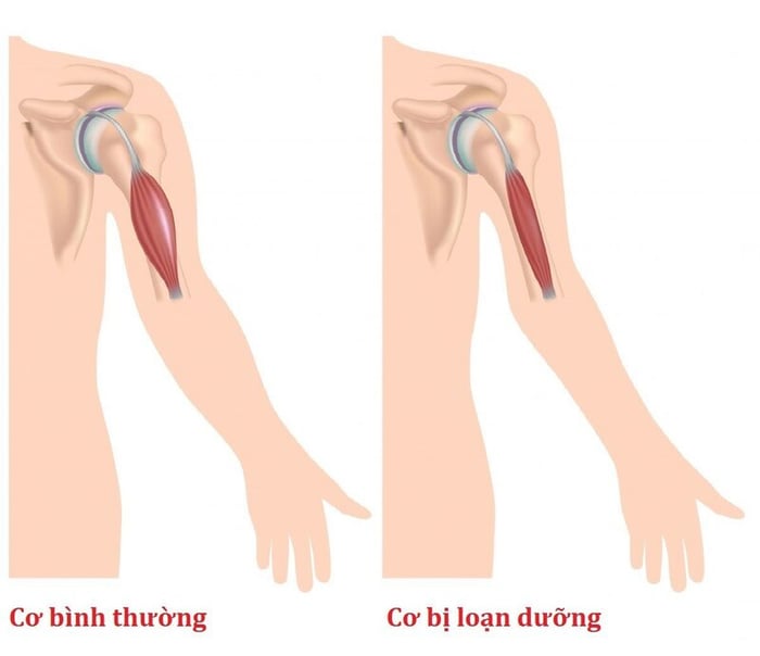 Loạn dưỡng cơ dần dần làm giảm khối lượng cơ trong cơ thể