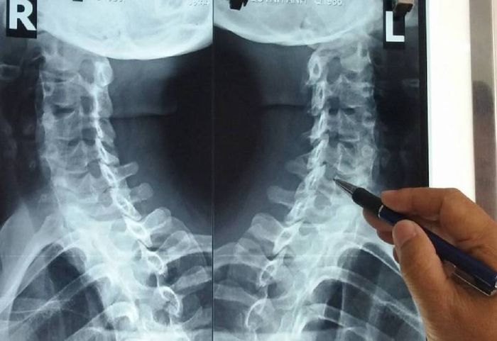 Để đánh giá thoát vị đĩa đệm trên X-quang, bác sĩ tiêm chất cản quang vào khoang dưới tủy sống để đánh giá bao rễ thần kinh.