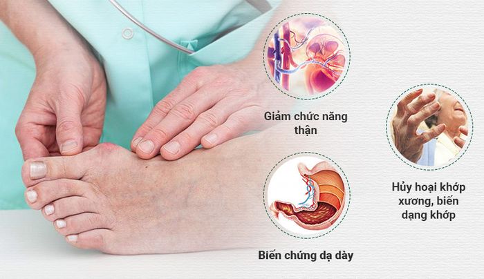 Các biến chứng cho thấy Bệnh giả Gout có nguy hiểm không?