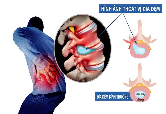 Chụp X-quang và việc phát hiện thoát vị đĩa đệm
