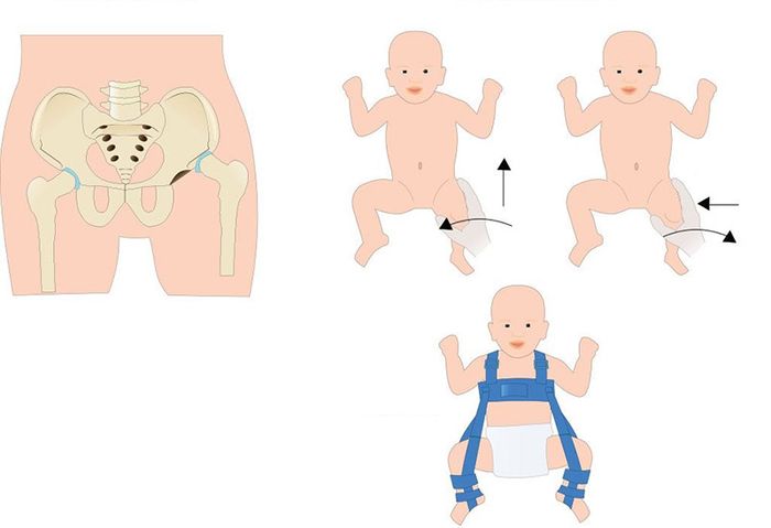 Trong quá trình điều trị, trẻ cần được thăm khám và kiểm tra định kỳ để theo dõi tiến triển của sự hồi phục, cũng như thực hiện các biện pháp can thiệp thích hợp.