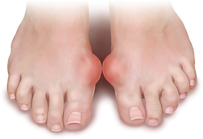 Cơn đau do bệnh Gout thường bắt đầu từ khớp ngón tay chứ không phải từ đầu gối như bệnh Giả Gout