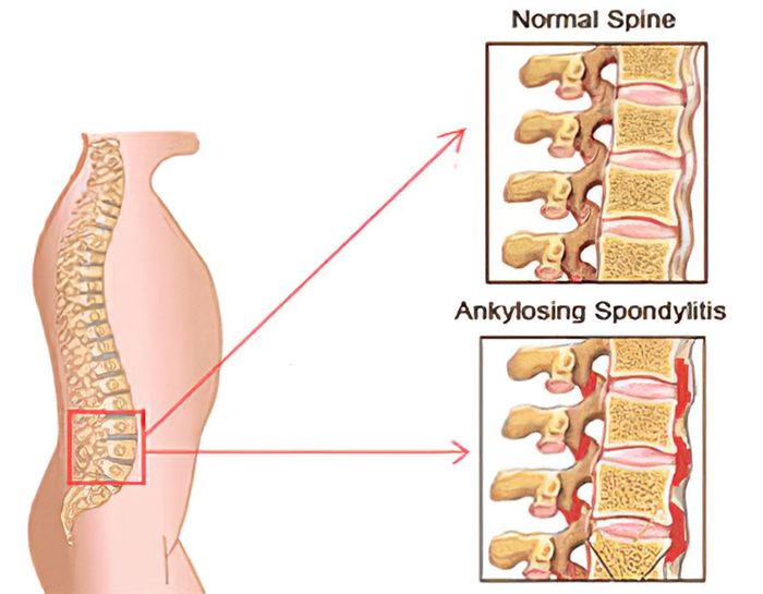 Ảnh hưởng của bệnh viêm cột sống dính khớp đối với khả năng vận động của bệnh nhân