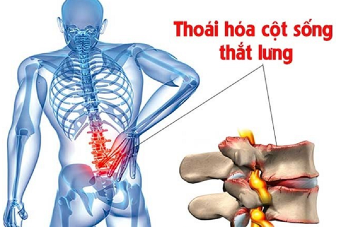 Thoái hóa cột sống có thể là nguyên nhân gây ra tiếng kêu khi vặn cơ thể