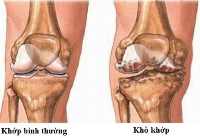 Khô khớp gối có thể tạo ra tiếng kêu lạo xạo khi di chuyển